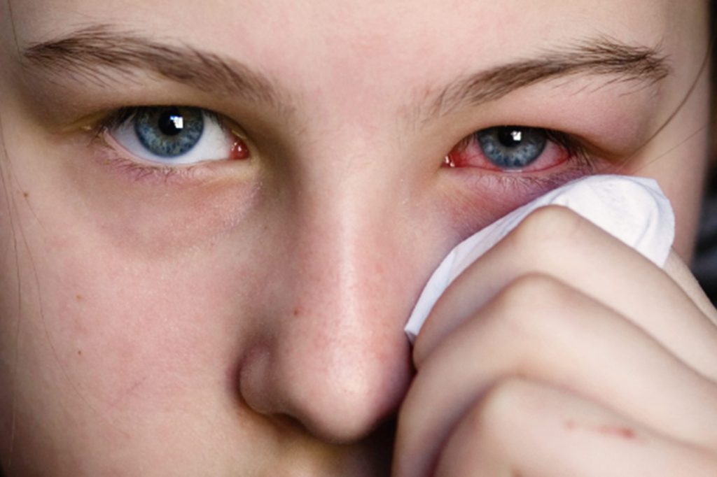 စရာသီမရွေး ဖြစ်ပွားနိုင်သည့် မျက်မြှေးရောင်ရောဂါကို ကာကွယ်၊ ကုသနိုင်မည့် နည်းလမ်းများ